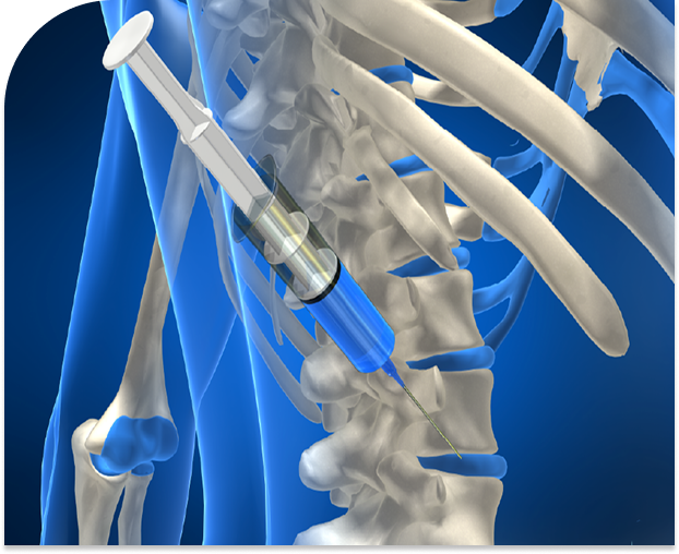nerveblock